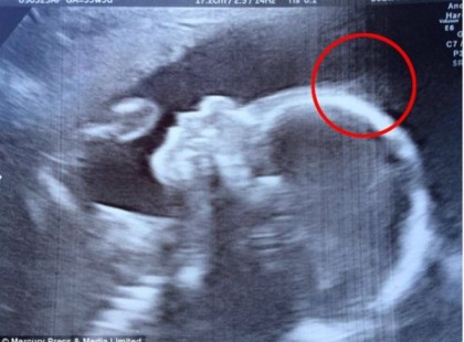 Az orvosok megrökönyödnek, amikor az ultrahangon valami furát vesznek észre a kicsi fején: Így néz ki napjainkban a kisbaba!