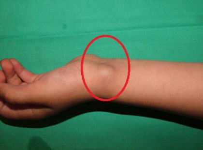 Emiatt van sokaknak csomó a csuklójuk közelében: