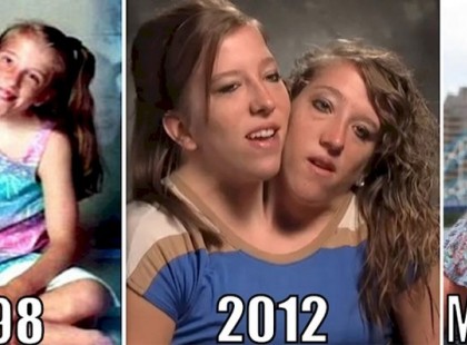 Idén betöltötték a 30. életévüket a sziámi ikrek! Lényeges közleményt adtak ki