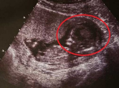 Az orvosok 100%-ig biztosak benne, hogy a születendő magzat végzetes károsodással jön majd világra. Amikor azonban kiemelik az újszülött apró kis fejecskéjét, olyasmit látnak rajta, amire nincs orvosi magyarázat