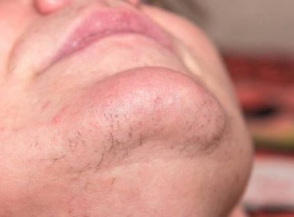 Minden nőnek! Ha neked is vannak szőrszálak az arcodon, nagy veszélyben lehetsz!