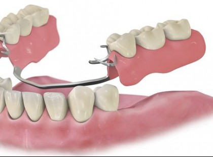 2022. JANUÁR 1-TŐL életkortól függetlenül jár a fogpótlásra az állami támogatás! 62 év alatt és 62 év felett is jár!!! Rengeteg pénzt jelent, ne hagyjuk veszni! Cseréltessük ki fogainkat ah szükség van rá! >>>