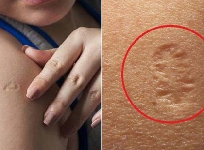 Te is kaptál ilyet? Ha neked is meg van ennek a védőoltásnak a helye, most nagyon figyelj!