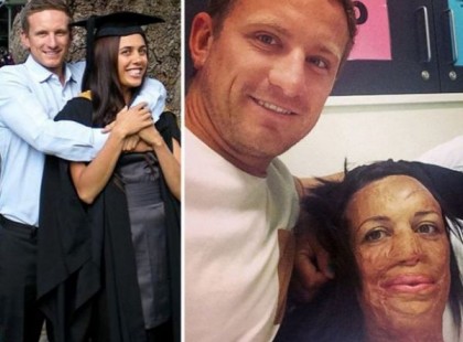 Ez az Igazi szerelem! Kitartott összeégett párja mellett, és feleségül veszi a jóképű férfi!