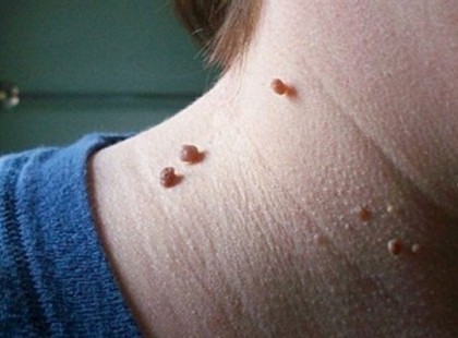 Nagyanyámtól tanultam: ezért nincs szemölcs, barna folt, anyajegy a bőrömön sehol, nem is gondolnád, hogy miért…