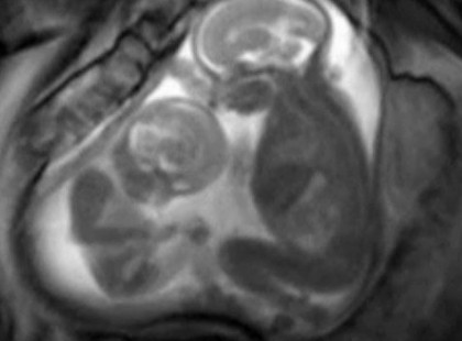 A várandós hölgy bejelentkezik MRI vizsgálatra. Megdöbbentő, amit a MÉHÉBEN találnak