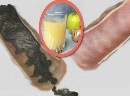 Vastagbeled teljesen tele van méreganyagokkal és pont ezért nehéz fogynod is! Ezzel a recepttel megoldódik a probléma!