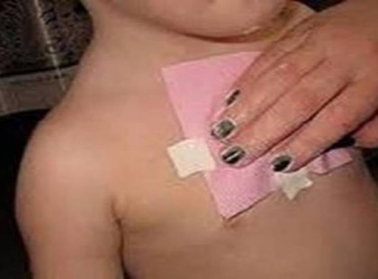 Gyógyító borogatás: meggyógyítja az erős köhögést, eltávolítja a váladékot a tüdőből mindössze 1 éjszaka alatt!