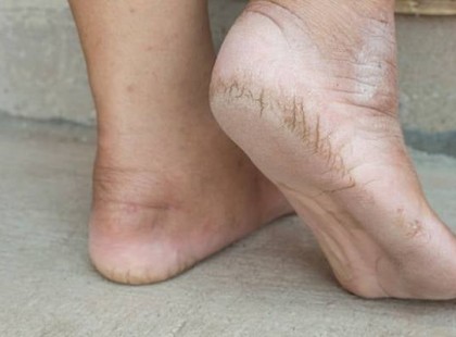 Szinte senki nem tud róla – Ha neked is van bőrkeményedésed, ebben a betegségben szenvedsz!