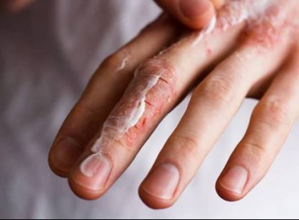 A szódabikarbóna 47 gyógyhatása és alkalmazása, aminek a felét sem ismerjük!