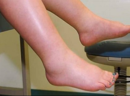 Dagad a lábad? Izületi gyulladásod van? Ez a csodás házi praktika megoldja a problémát!