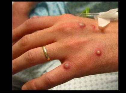 Világszerte terjed a majomhimlő – Ezek a tünetei és így terjed