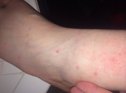 Reggel jött a hír! Villámgyorsan terjedő bőrkiütés ütötte fel a fejét – ha ilyen pöttyöket vagy foltokat fedezel fel magadon azonnal ellenőrizd az ágyadat, könyveidet, függönyeidet, szőnyegeket, szekrényeket, az összes ruhát és a bőröndöket is! Mutatjuk mit kell keresned :