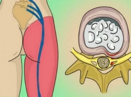 Barátnőm visszatérő, erős hátfájással küzdött. Megtanulta ezt a 2 egyszerű mozdulatot, és bármikor le tudja győzni a fájdalmat: