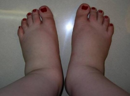 Gondod van a vizesedéssel? Íme 10 módszer, ami fokozza a nyirokkeringést!