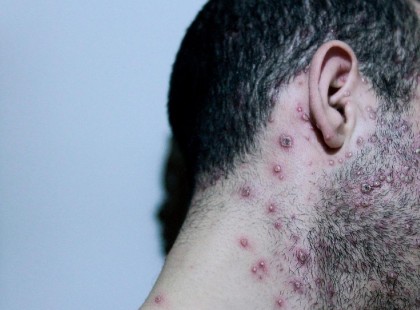 Ő az a 38 éves férfi akinél azonosították a majomhimlőt.Ezeket a tüneteket tapasztalta