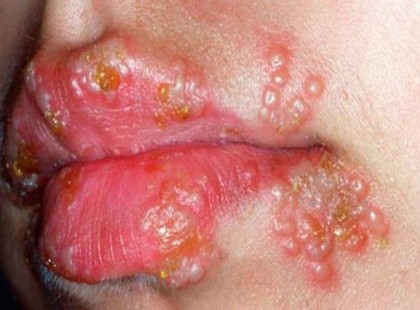 Ez az egyetlen természetes orvosság herpesz ellen, ami órákon belül hat!