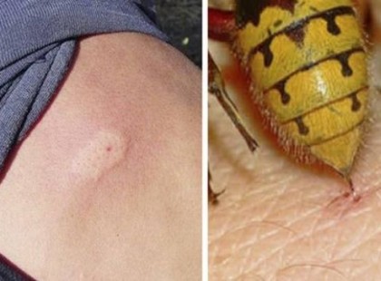 5 dolog, amit AZONNAL tenni kell, ha egy méh vagy darázs megcsíp és 3 dolog, amit sürgősen felejts el!