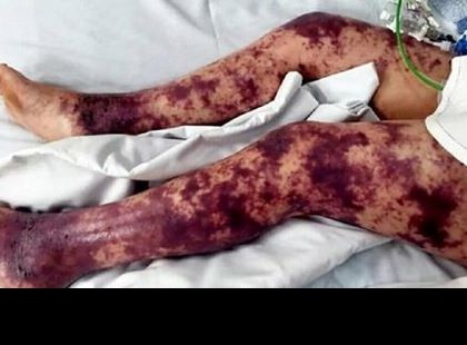 A 7 éves kislányomon egyre több kék folt jelent meg – mikor megtudtam miért már túl késő volt