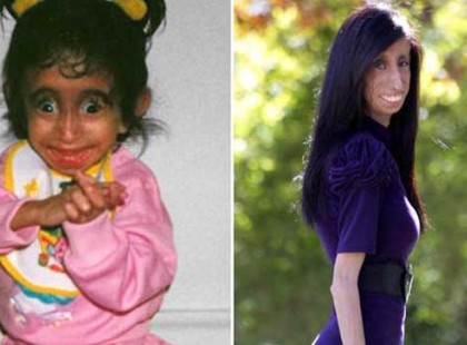 Folyamatosan bántották, szekálták, és többször nyilvánosan a világ legcsúnyább nőjének nevezeték őt. Így néz ki ma Lizzie Velasquez: