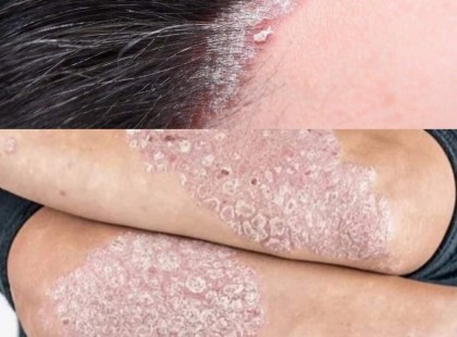 A 7 jel, ami a pikkelysömörre utalhat; a betegségnek nincs gyógymódja, és Magyarországon több mint 200.000ezren szenvednek a betegségben!