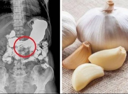 Az orvosom tanácsára minden nap ettem fokhagymát, ez lett a következménye!