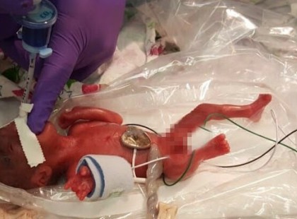 Igazi hős ez az apró csoda! Életben maradt a 245 grammal született kislány