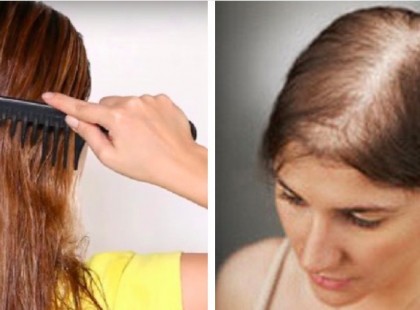 Kopaszodsz? Egy orvos elárulta azt a házi módszert, amivel mindössze hét nap után visszatér a sűrű hajkorona!