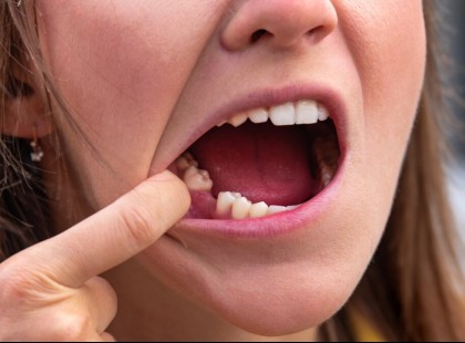 VILÁGSZENZÁCIÓ: ELKEZDIK EMBEREKEN KIPRÓBÁLNI A FOGNÖVESZTŐ GYÓGYSZERT, IDEJE A FOGTÜNDÉRNEK NYUGDÍJBA MENNIE! Nem lesznek többé kihulló, kihúzni való lyukas fogak.