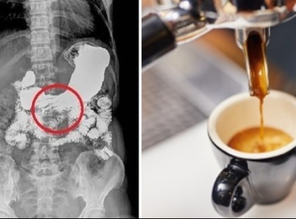 Az orvosom tanácsára minden nap ittam kávét , ez lett a következménye!