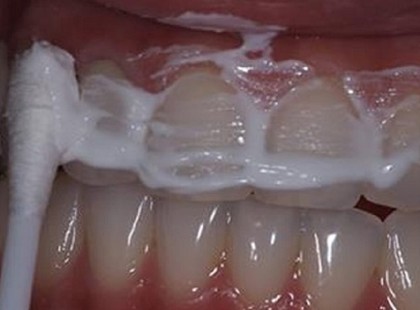 A barátnőm férje fogorvos, ő tanította meg 4 perc alatt kifehéríteni a fogam, és eltünteti a fogkövet róla