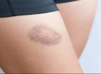 Az agyvérzés előtt egy hónappal ezeket a jeleket küldi a tested! Jobb ha figyelsz