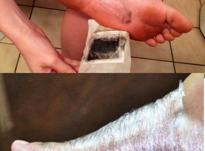 Készíts éjszakai méregtelenítő pakolást, ami kiszívja reggelre a betegséget