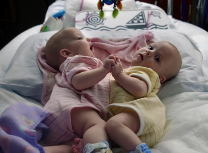 Ezeket a sziámi ikreket mindössze 6 hónapos korukban választották szét – így néznek ki 18 évvel később