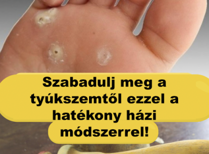 Szabadulj meg a tyúkszemtől ezzel a hatékony házi módszerrel! ?✨
