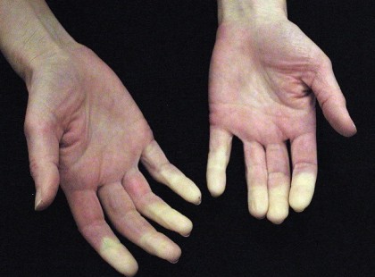 Íme 10 jel!A halál jelei testünkön is megmutatkozhatnak. Íme a leggyakoribb tünetek