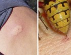 Sokan nem tudják!6 dolog, amit AZONNAL tenni kell, ha egy méh vagy darázs megcsíp és 3 dolog, amit sürgősen felejts el