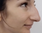 A lány plasztikai műtéten esett át az orrán, és most már a családja sem ismeri fel! 😲 🤕