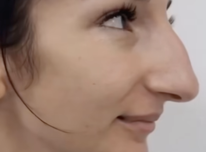 A lány plasztikai műtéten esett át az orrán, és most már a családja sem ismeri fel! ? ?