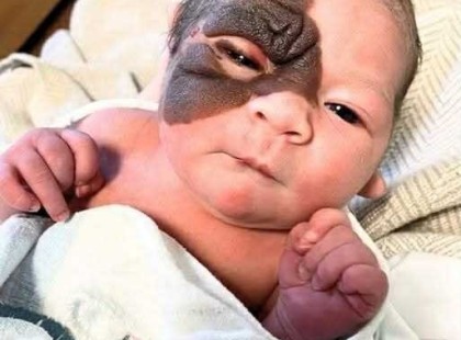 Egyedi anyajeggyel született – ez a bátor kislány szívmelengető átalakuláson ment keresztül: nézd meg a fotókat, és olvass tovább, ha szeretnéd, hogy elolvadjon a szíved! ??