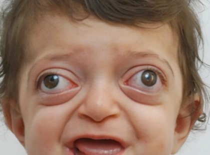 Az orvosok átformálták egy kisfiú különleges arcát – nézd meg, hogyan változott meg teljesen az élete!