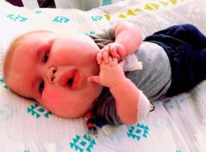 Így néz ki ma az a kisfiú, aki szokatlanul nagy arccal született! Nézd meg a fotókat! ??