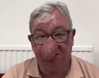 Az idős nagypapa műtéten esett át az orrán, és most már a családja sem ismeri fel! 😲 🤕