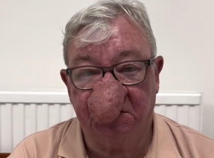 Az idős nagypapa műtéten esett át az orrán, és most már a családja sem ismeri fel! ? ?