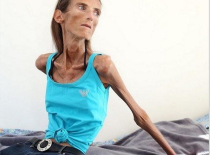 „Harcom az anorexia ellen” – egy lány története, aki túl messzire ment…