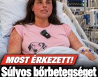 Súlyos bőrbetegséget kapott Agárdi Szilvi.