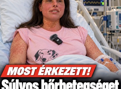 Súlyos bőrbetegséget kapott Agárdi Szilvi.